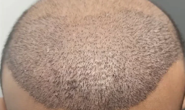  زراعة الشعر: اهميتها فوائدها ونتائجها هي استعادة الثقة في نفسك وجمالها الطبيعي